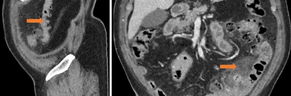 Divertikulose Des Darmes Springermedizin De