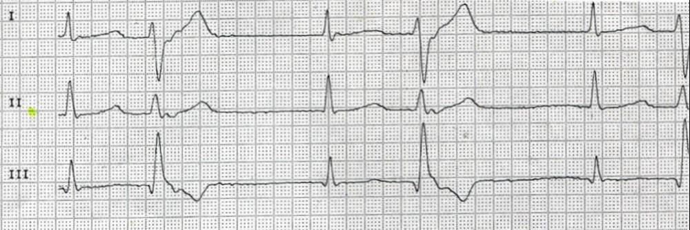Herzrhythmusstorungen Herzrhythmusstorungen Springermedizin De