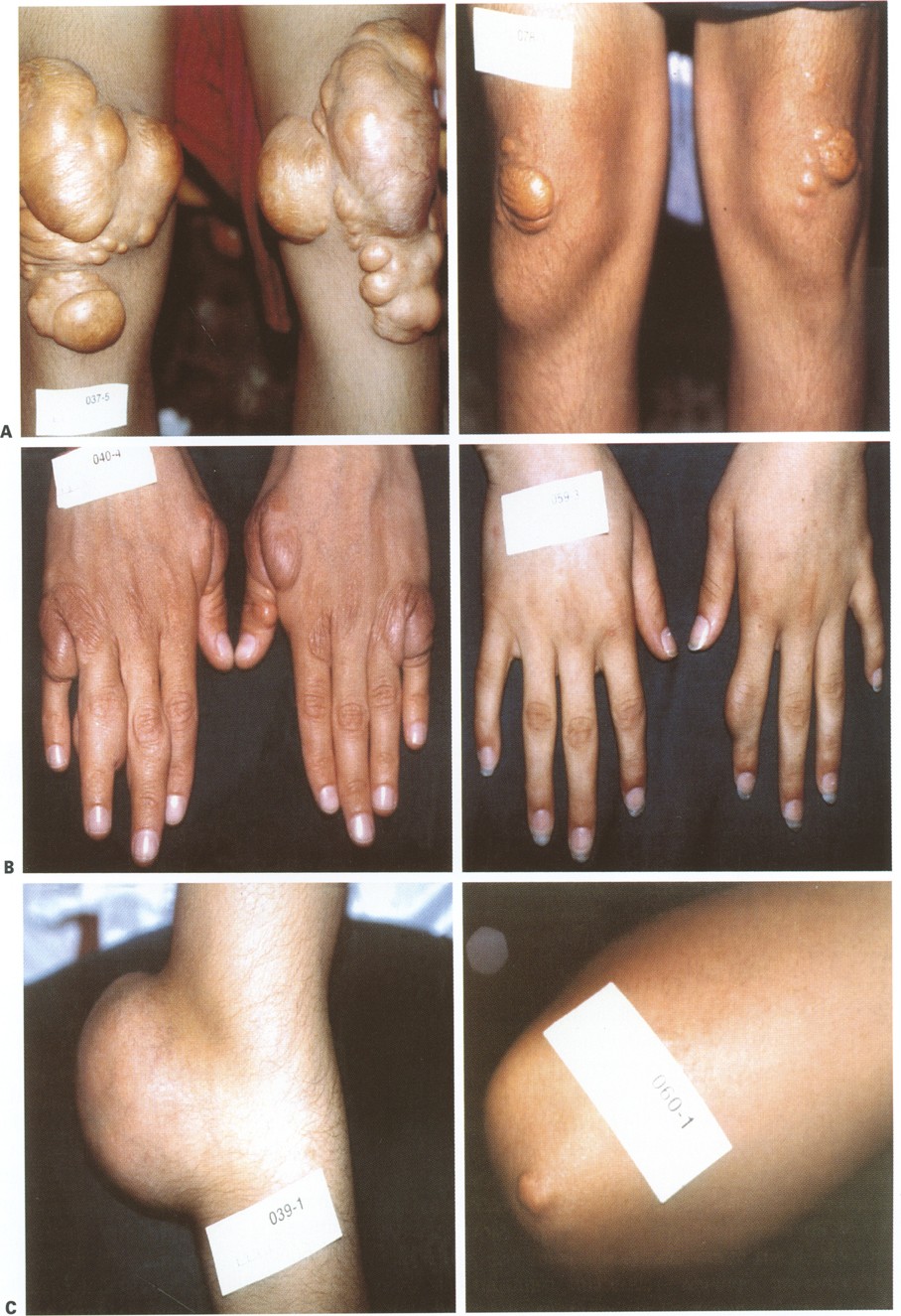 Xanthomas and Abnormalities of Lipid Metabolism and Storage | Springer  Nature Link (formerly SpringerLink), image size:908x1325