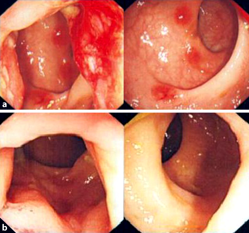 Proktitis (ohne chronisch-entzündliche Darmerkrankung) | coloproctology