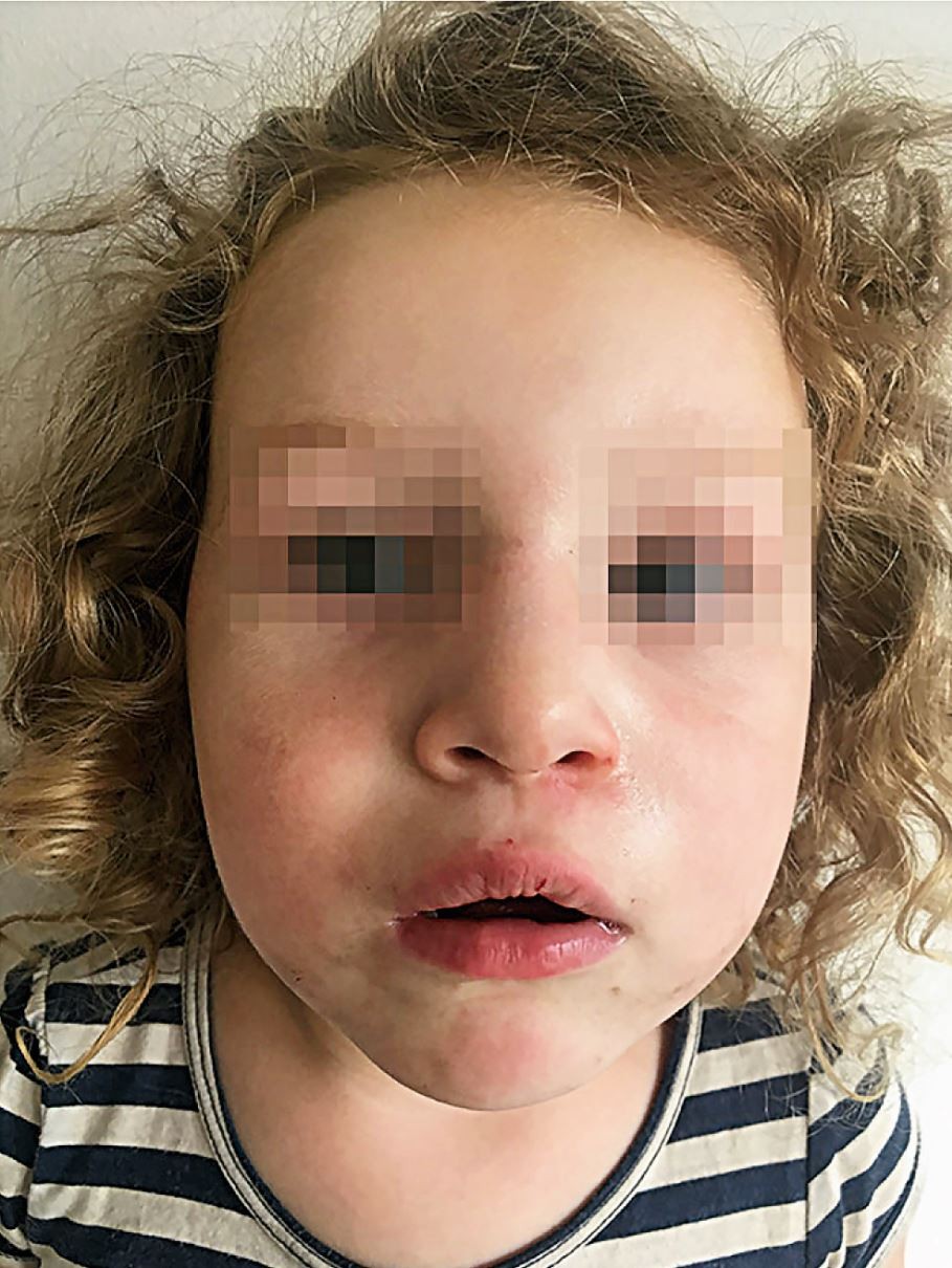 Endoskopische versus konventionelle Adenotomie | HNO Nachrichten, image size:909x1210