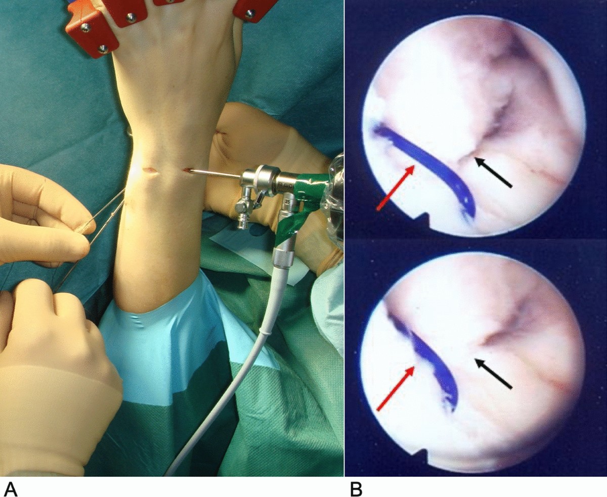 tfcc tear and using bpc 157 Long-term results of more than 13 years after arthroscopic repair of triangular  fibrocartilage complex (TFCC) Palmer 1B tears: a comparison with short- and  mid-term results