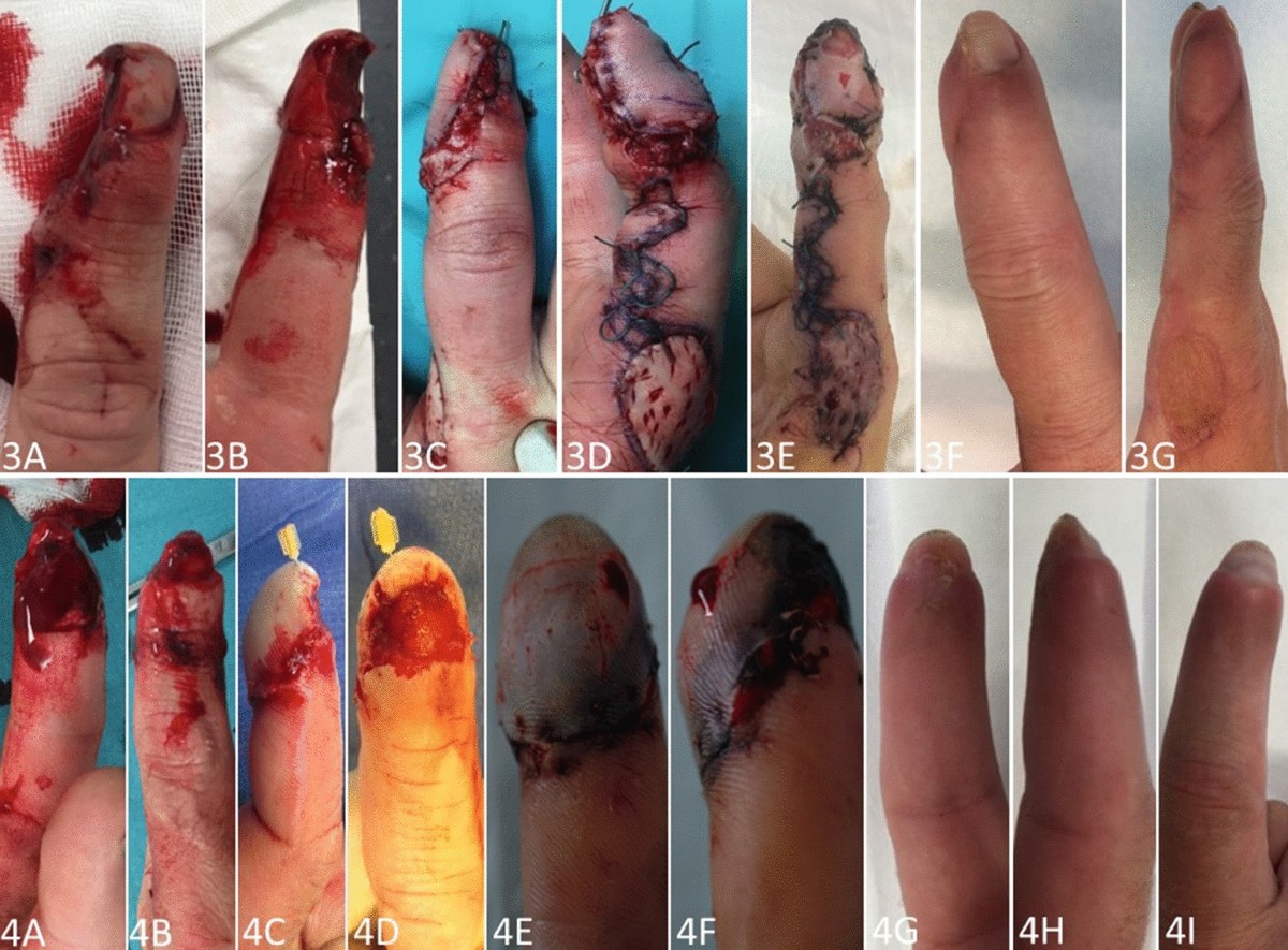dressing a cut finger tip Amazon.com: MediMitt FingerMitt