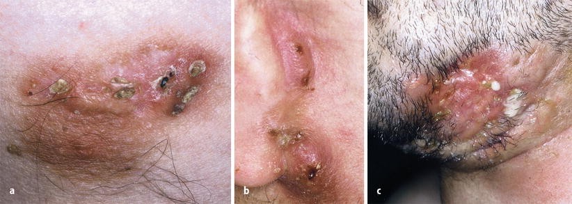 Acne inversa | Die Dermatologie | Springer Nature Link Acne inversa | Die Dermatologie | Springer Nature Link