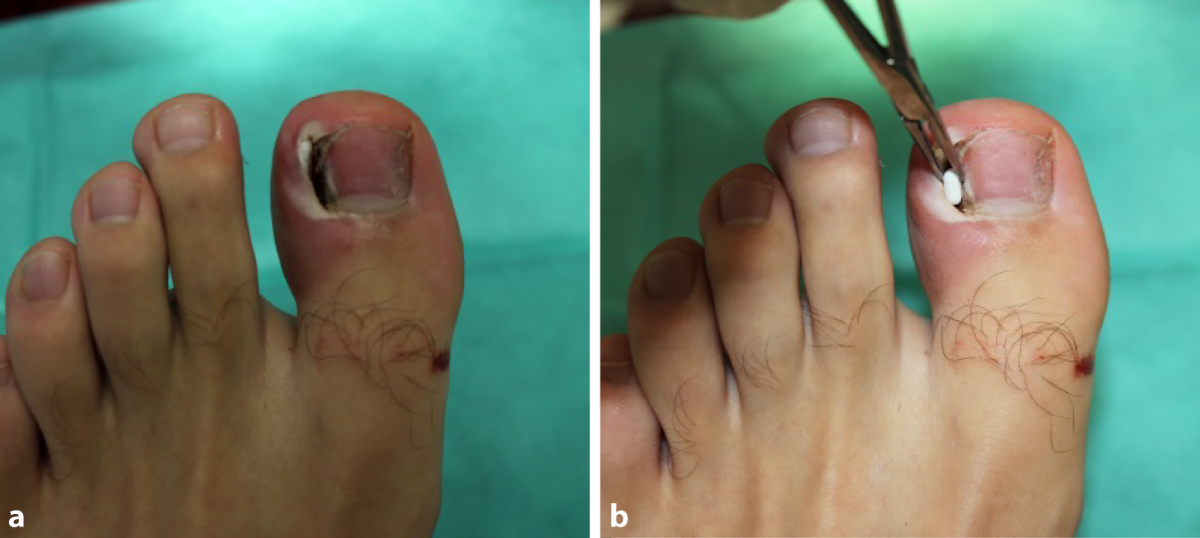 Eingewachsene Zehenngel  Optionen fr die tgliche Praxis | Die  Dermatologie | Springer Nature Link