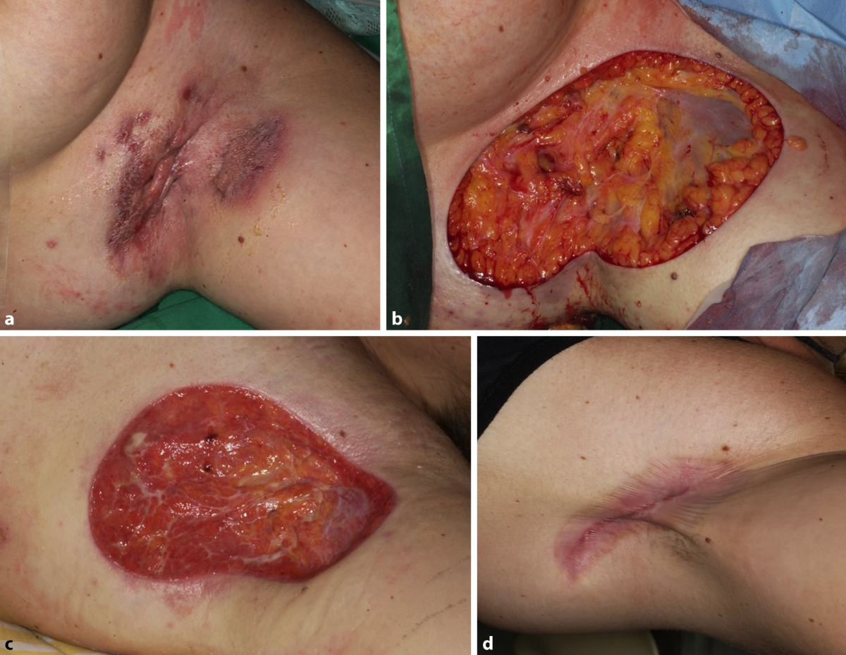 Hidradenitis suppurativa/Acne inversa  operative Optionen,  Rekonstruktionen und Kombinationen mit medikamentsen Therapien  Ein  Update | Die Dermatologie | Springer Nature Link
