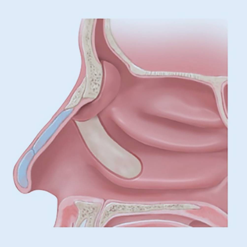 Lokale Lappenplastiken bei der Stirnhöhlendrainage Typ II und III nach Draf  | HNO, image size:1003x1004