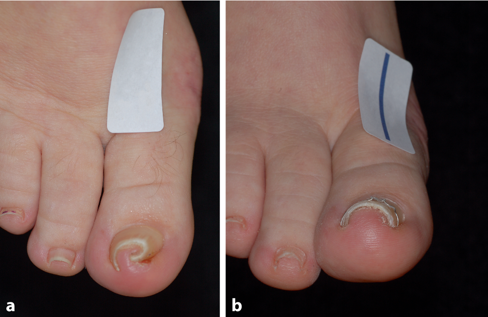 Nagelpflegeöl 18ml - Behandlung Für Fingernägel & Fußnägel Mit Pinselapplikator