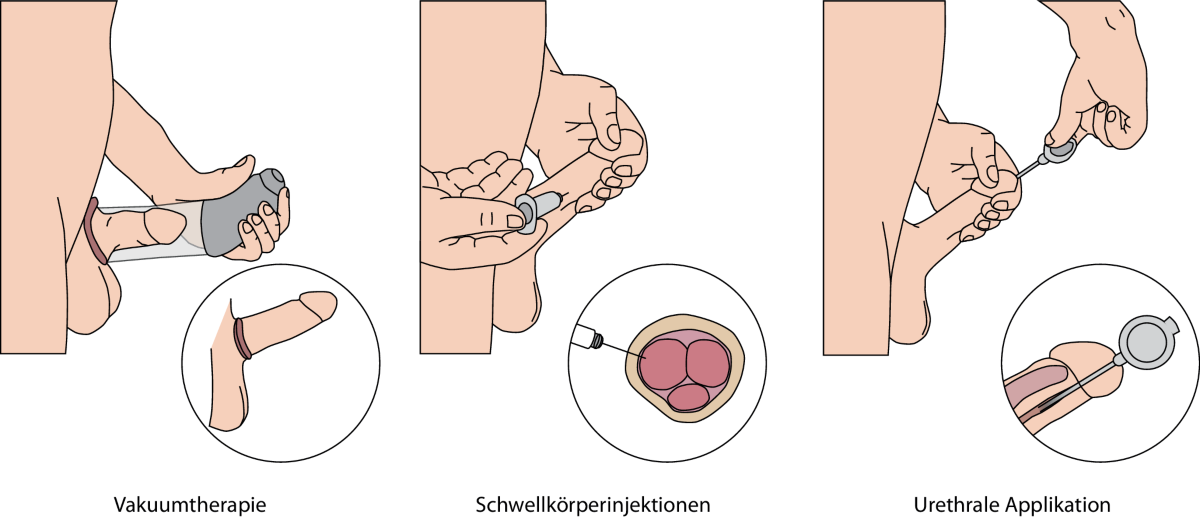 Erektile Dysfunktion  es ist Zeit zum Handeln! | Die Urologie | Springer  Nature Link