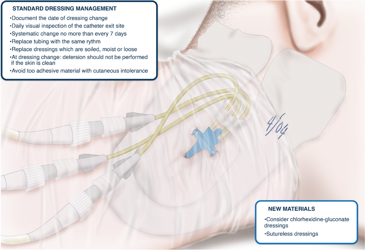 Catheter dressings | Intensive Care Medicine | Springer Nature Link
