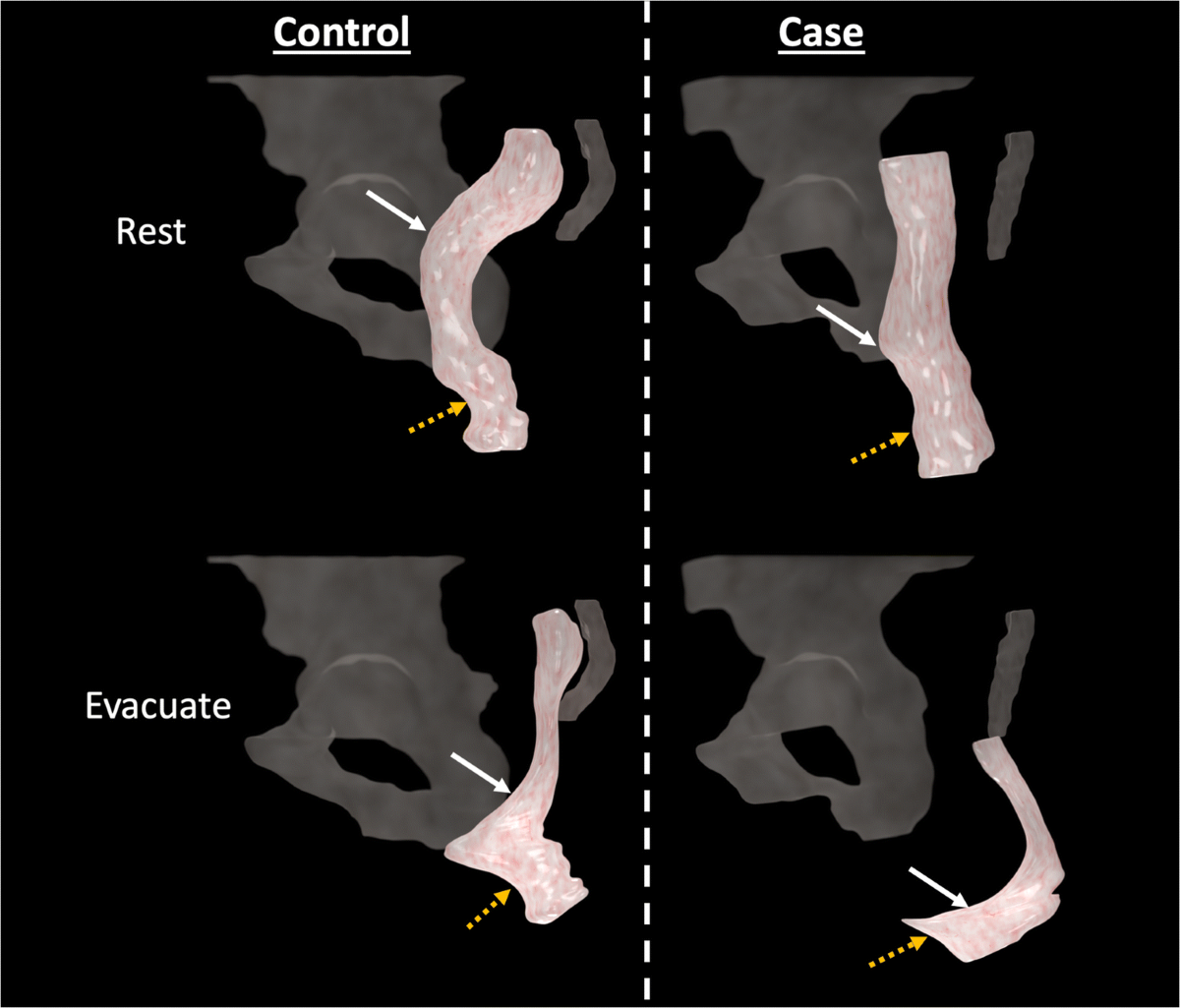 Descent and hypermobility of the rectum in women with obstructed defecation  symptoms | International Urogynecology Journal