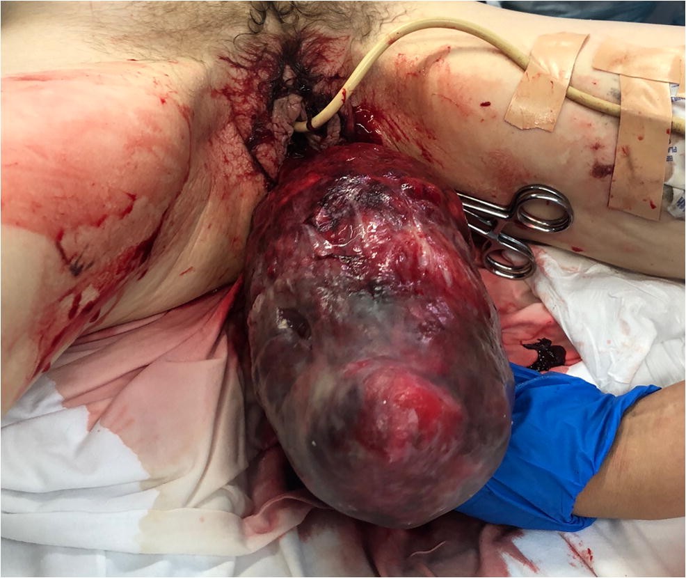 prolapsed uterus women foto 