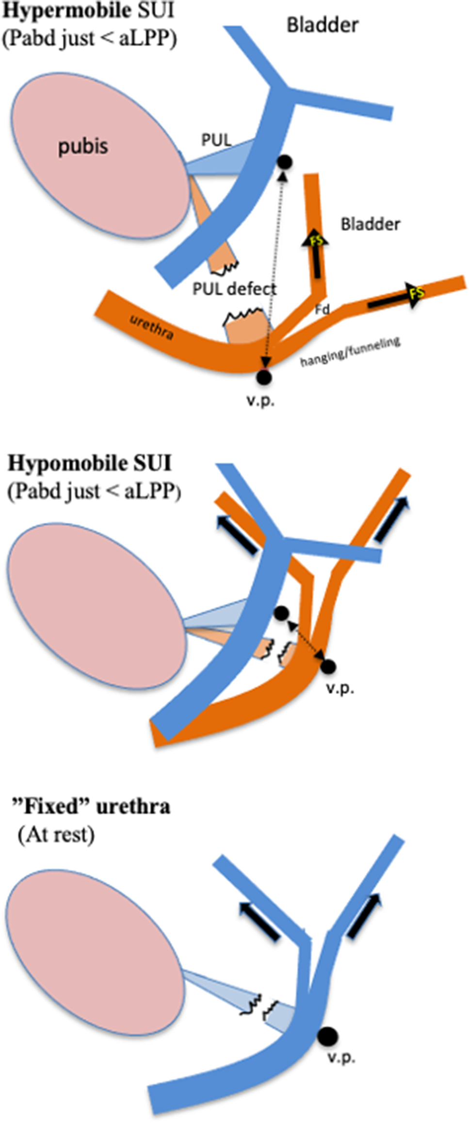 Stress urinary incontinence is caused predominantly by urethral 