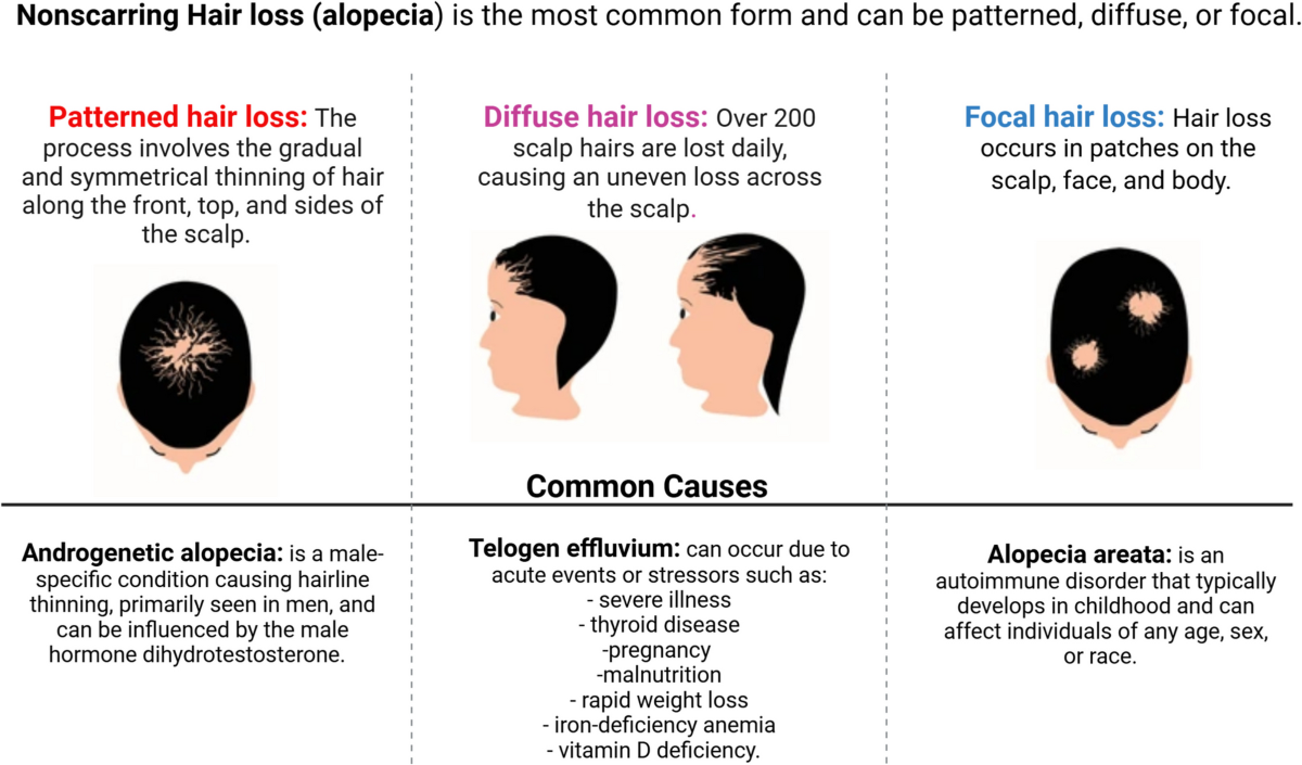 Pathophysiology, conventional treatments, and evidence-based herbal  remedies of hair loss with a systematic review of controlled clinical  trials | Naunyn-Schmiedeberg's Archives of Pharmacology | Springer Nature  Link