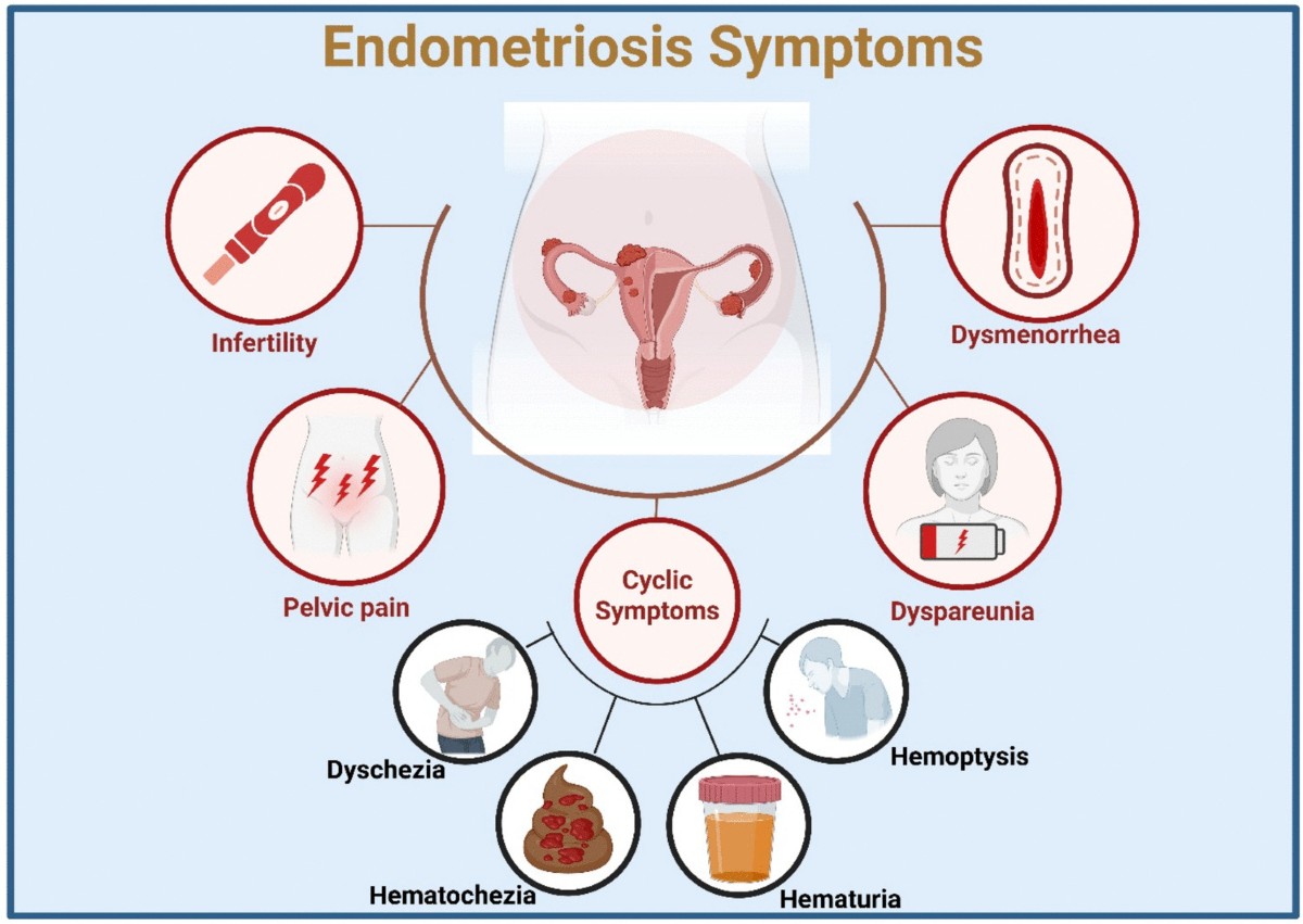 Natural bioactive compounds and herbal medicines targeting common signaling  pathways in endometriosis: mechanisms and therapeutic implications |  Naunyn-Schmiedeberg's Archives of Pharmacology