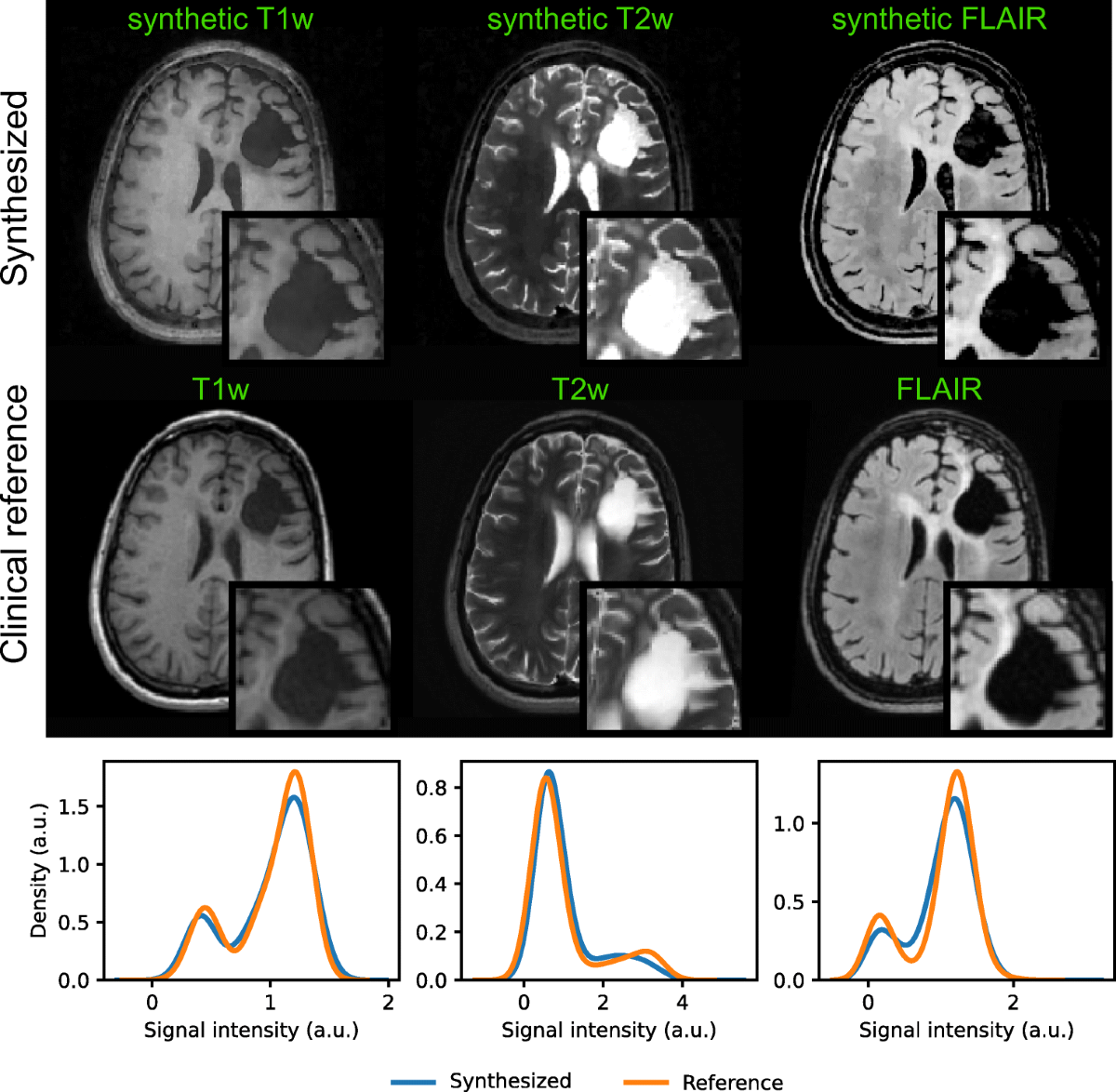 Accelerated 3D whole-brain T1, T2, and proton density mapping: feasibility  for clinical glioma MR imaging | Neuroradiology