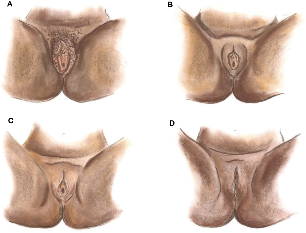 cut clitoris Female Genital Mutilation/Cutting | SpringerLink