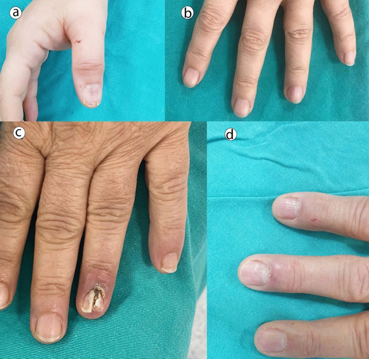 Glomus Tumor of the Nail Bed with Local Pain: A Case Report