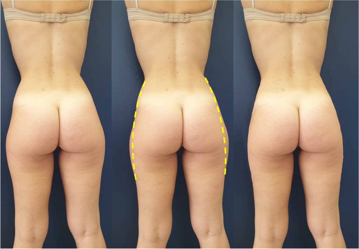 buttocks The ideal buttock: some aesthetic and morphometric considerations |  European Journal of Plastic Surgery