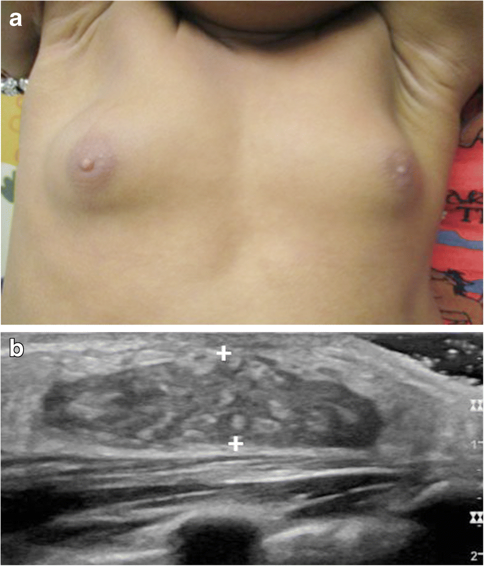 breast development 