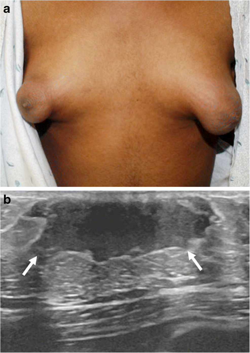 girls developing breast Breast development in pediatric patients from birth to puberty: physiology,  pathology and imaging correlation | Pediatric Radiology