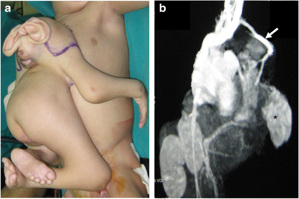 Postnatal imaging of conjoined twins: a customized multimodality approach |  Pediatric Radiology