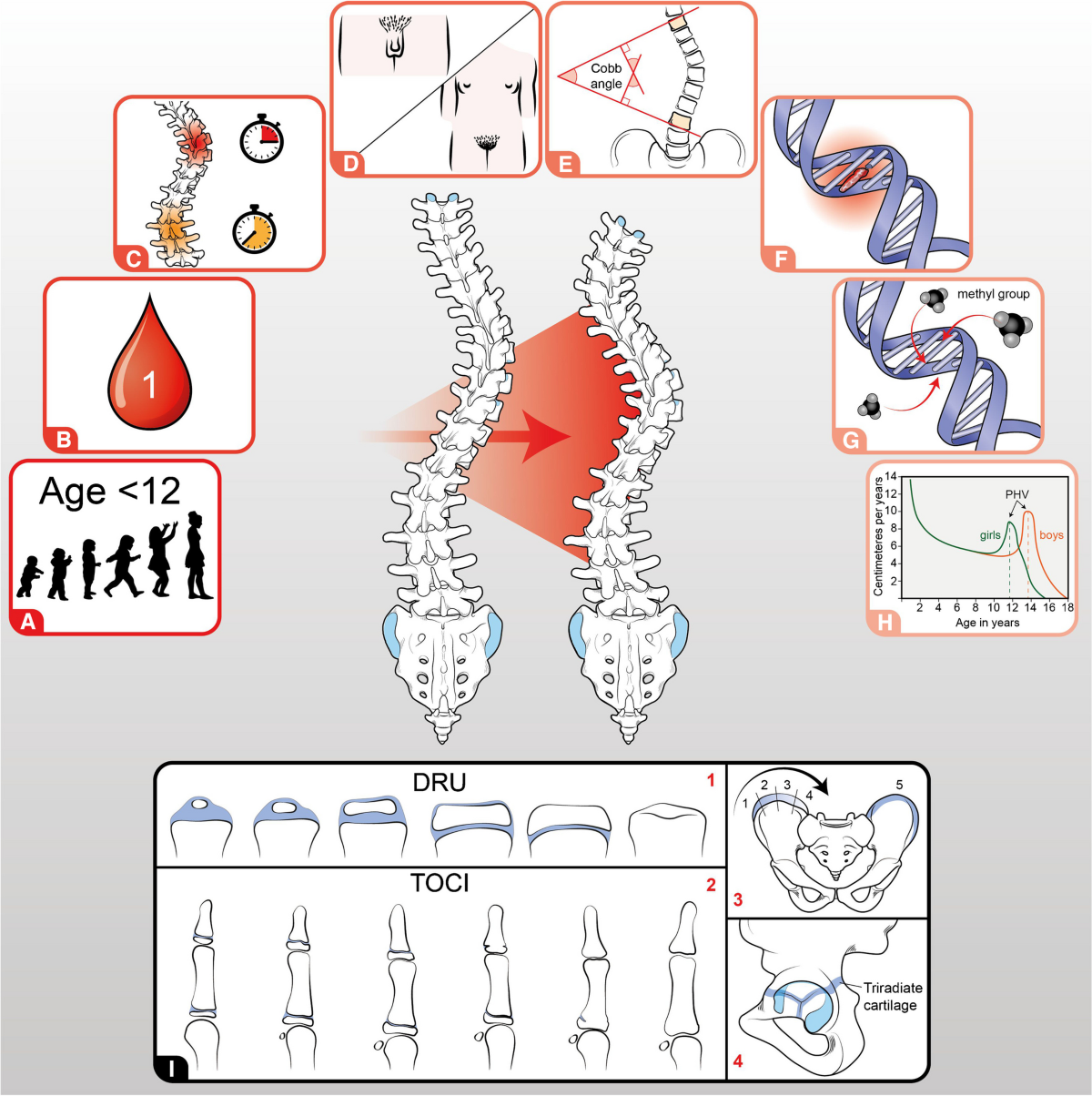 لماذا قد يزداد ألم اعوجاج العمود الفقري أثناء الدورة الشهرية؟