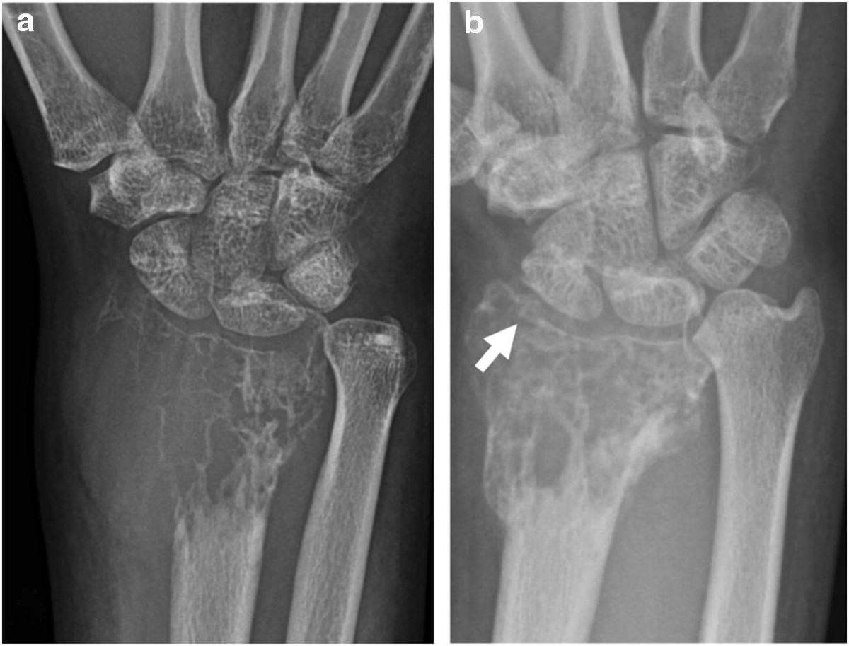 Radiological findings of denosumab treatment for giant cell tumours of bone  | Skeletal Radiology, image size:1200x913