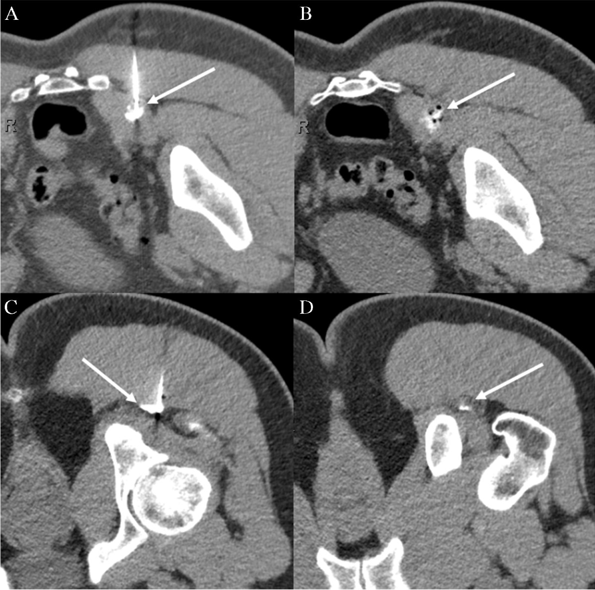 lidocaine b12 injections for piriformis syndrome syndrome: muscle thickness or volume does not correlate with response to CT-guided injection | Skeletal Radiology Size:50 ml 5-Amino (5-Amino-1MQ) McGuff Company