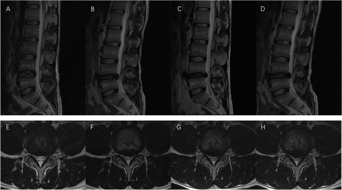 Life-Size Lumbar Vertebrae Model With Lumbar Nerve Section