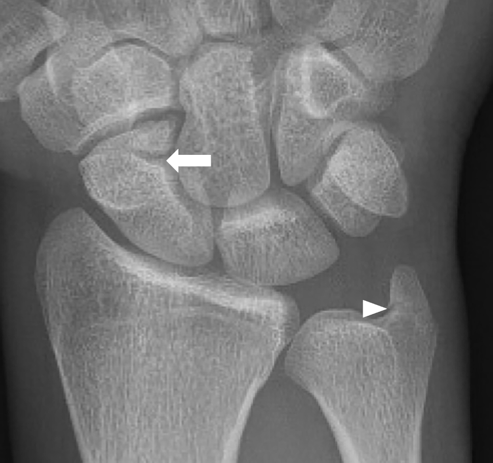 Os centrale carpi bone bruising simulating an acute scaphoid fracture |  Skeletal Radiology, image size:969x909