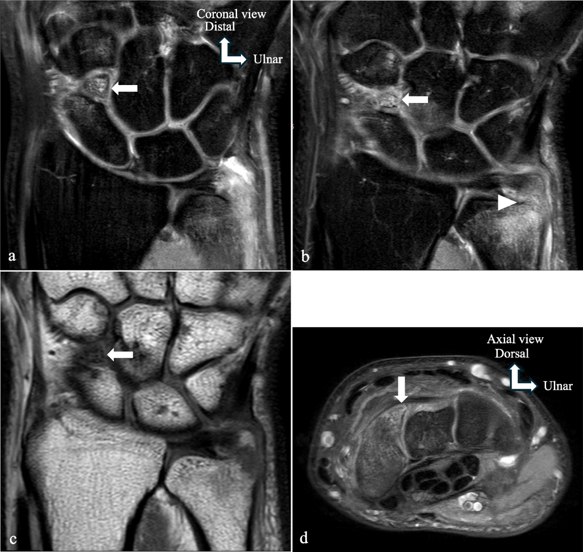 Os centrale carpi bone bruising simulating an acute scaphoid fracture |  Skeletal Radiology, image size:1200x1136