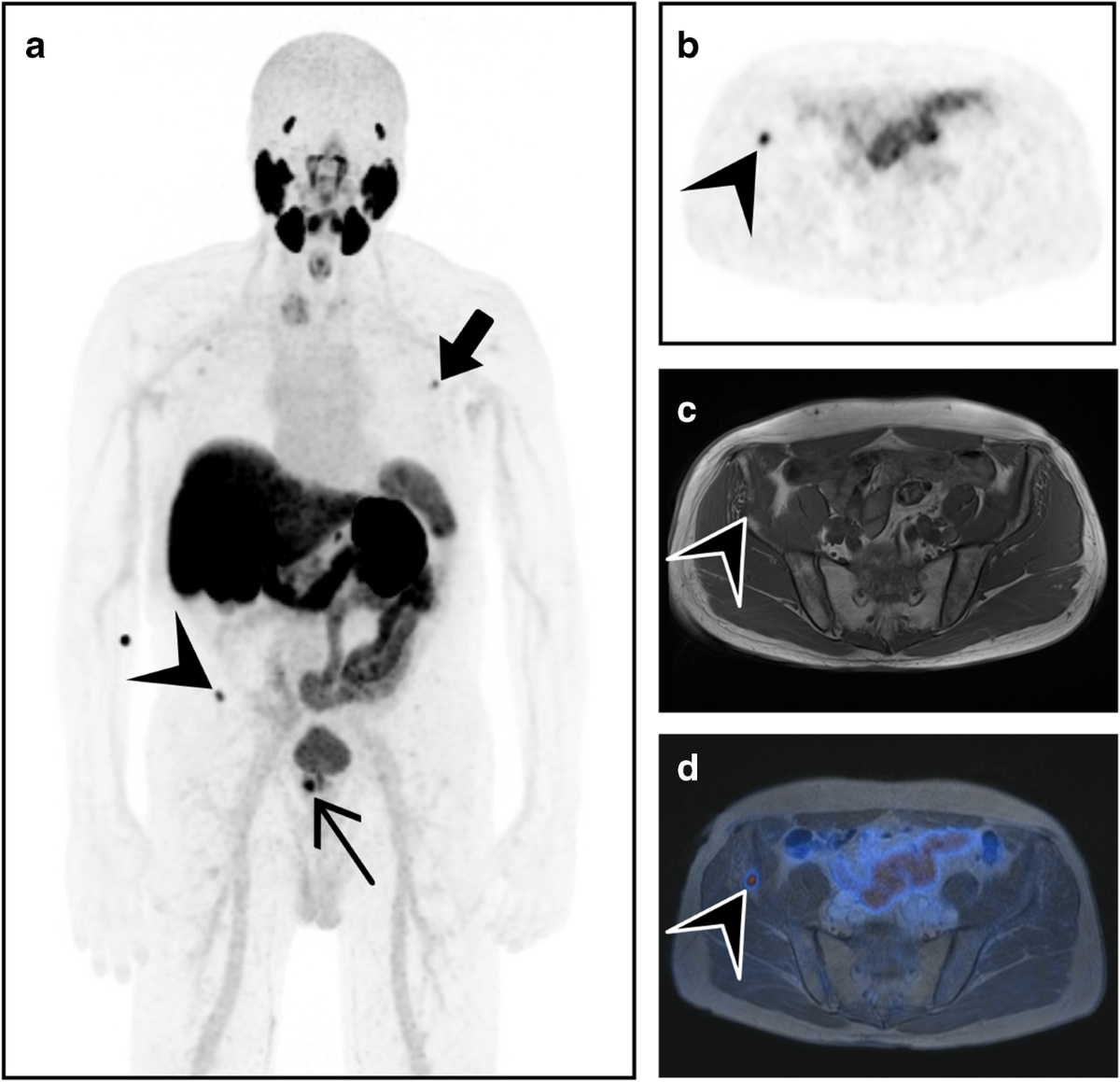 Focal unspecific bone uptake on [18F]-PSMA-1007 PET: a multicenter  retrospective evaluation of the distribution, frequency, and quantitative  parameters of a potential pitfall in prostate cancer imaging | European  Journal of Nuclear Medicine, image size:1200x1159