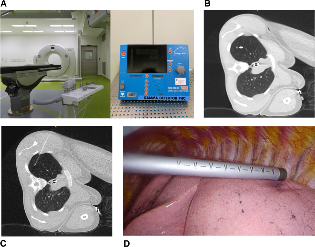 CT-guided percutaneous marking of small pulmonary nodules with  [99mTc]Tc-Macrosalb is very accurate and allows minimally invasive  lung-sparing resection: a single-centre quality control | European Journal  of Nuclear Medicine and Molecular Imaging, image size:1200x941
