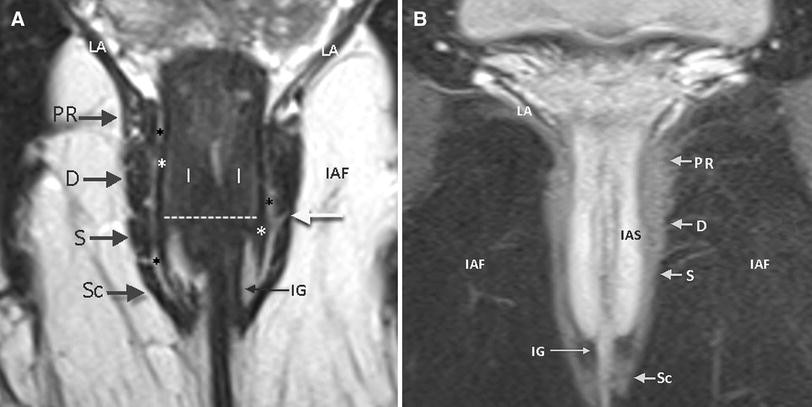 MRI of anal canal: normal anatomy, imaging protocol, and perianal fistulas: Part 1 | Abdominal Radiology | Springer Nature Link MRI of anal canal: normal anatomy, imaging protocol, and perianal fistulas: Part 1 | Abdominal Radiology | Springer Nature Link