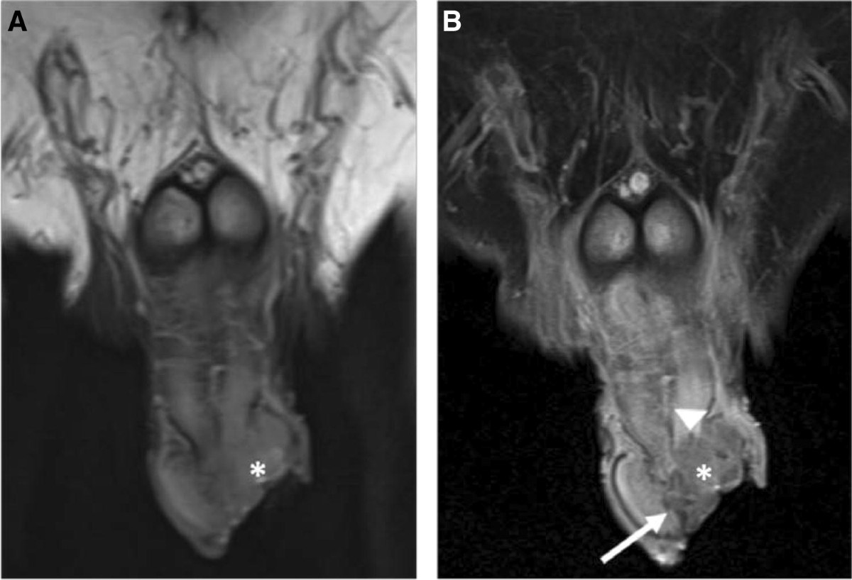 MRI of common penile pathologies and penile prostheses | Abdominal Radiology