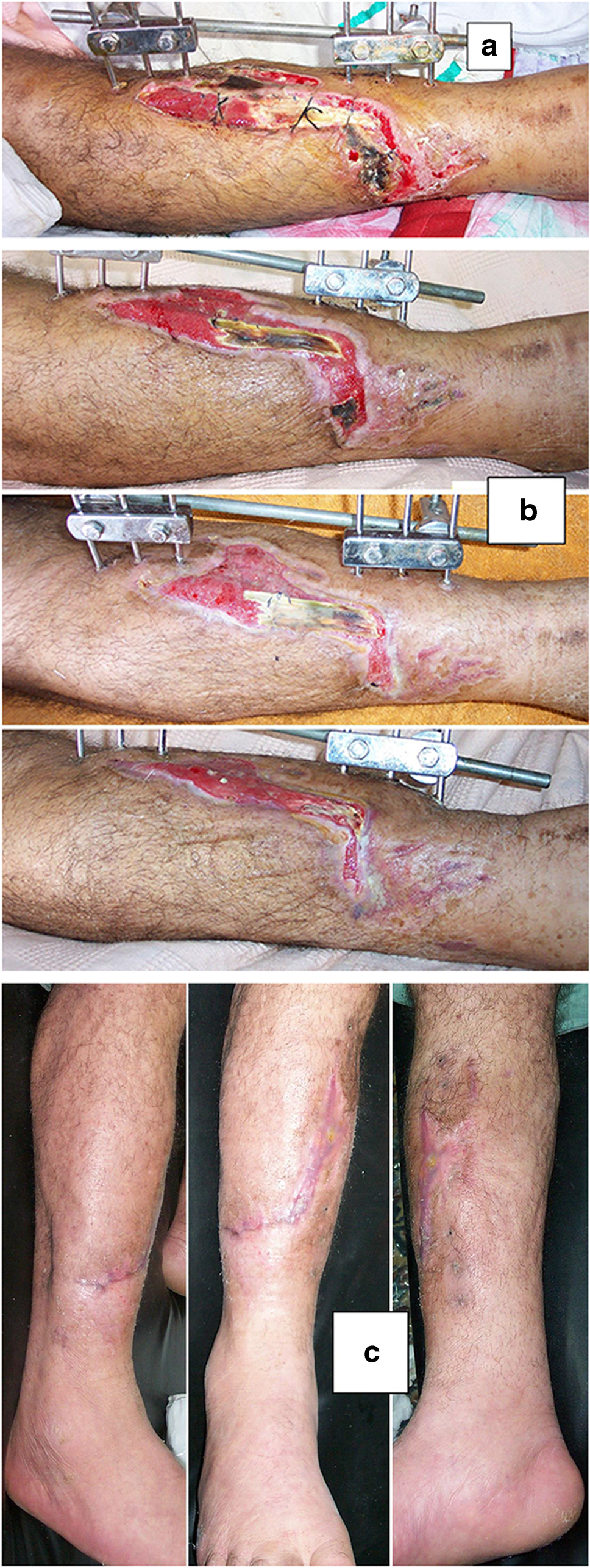 Honey dressing: a missed way for orthopaedic wound care | International Orthopaedics | Springer Nature Link Honey dressing: a missed way for orthopaedic wound care | International Orthopaedics | Springer Nature Link