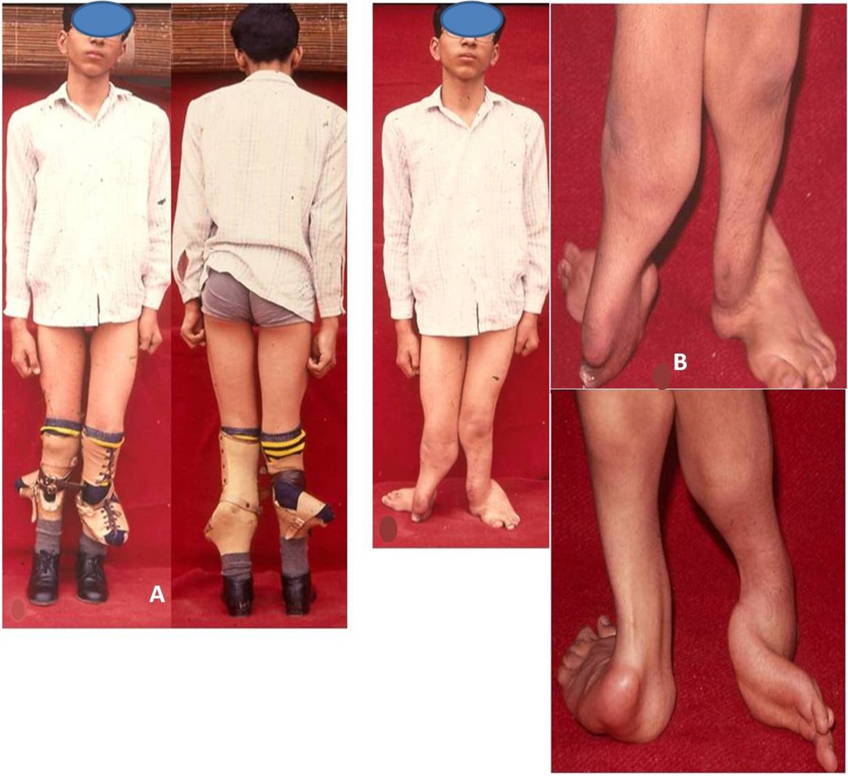 Fibular hemimelia: reconstruction of difficult cases with tibial  lengthening and ankle arthrodesis | International Orthopaedics, image size:1200x1098