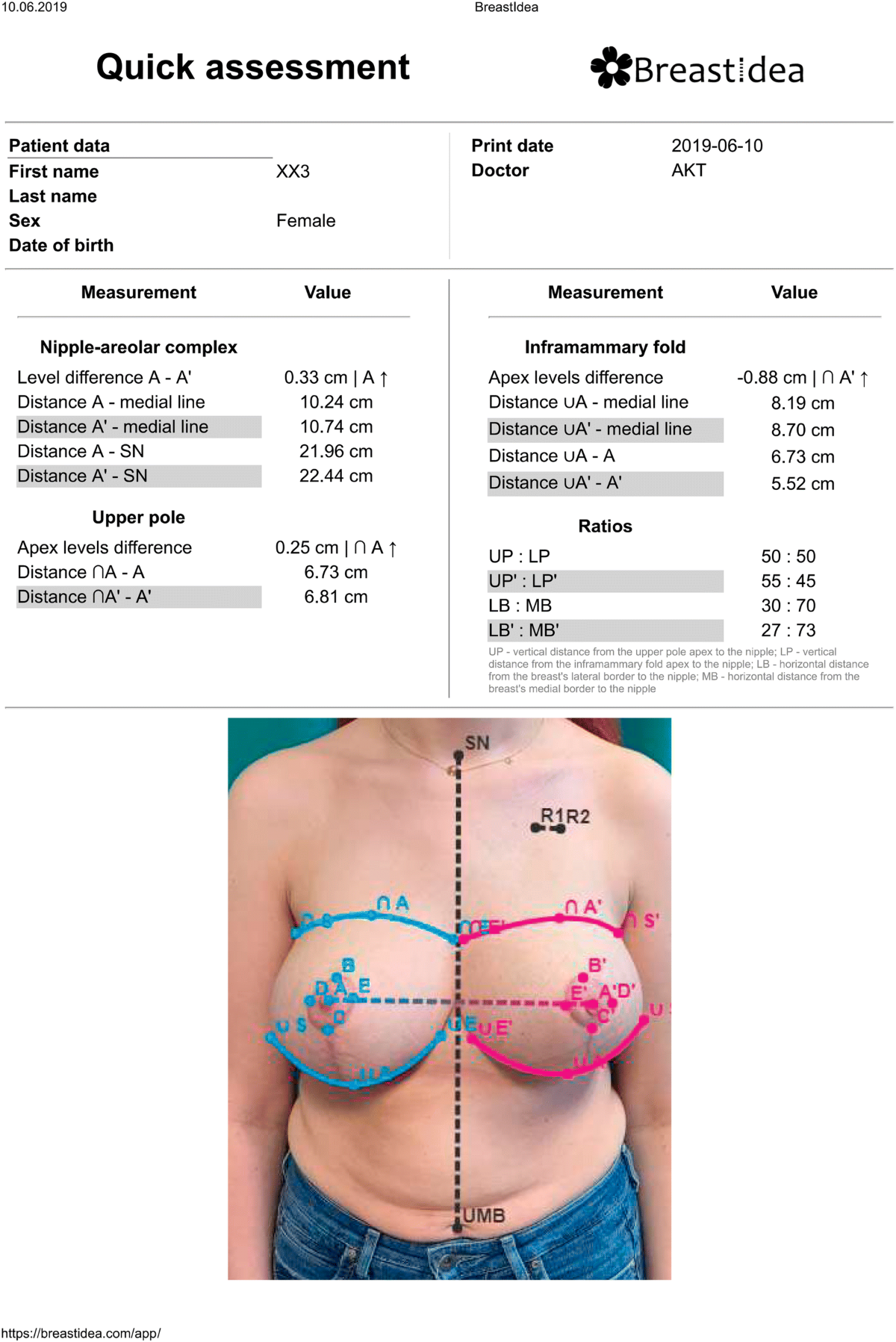 Breast anthropometric results for the following indexes: distance