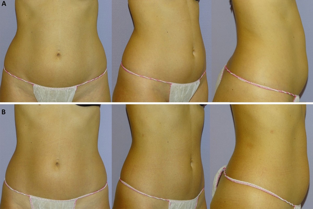 Body Contouring Using a Combination of Pulsed Ultrasound and Unipolar Radio  Frequency: A Prospective Pilot Study | Aesthetic Plastic Surgery