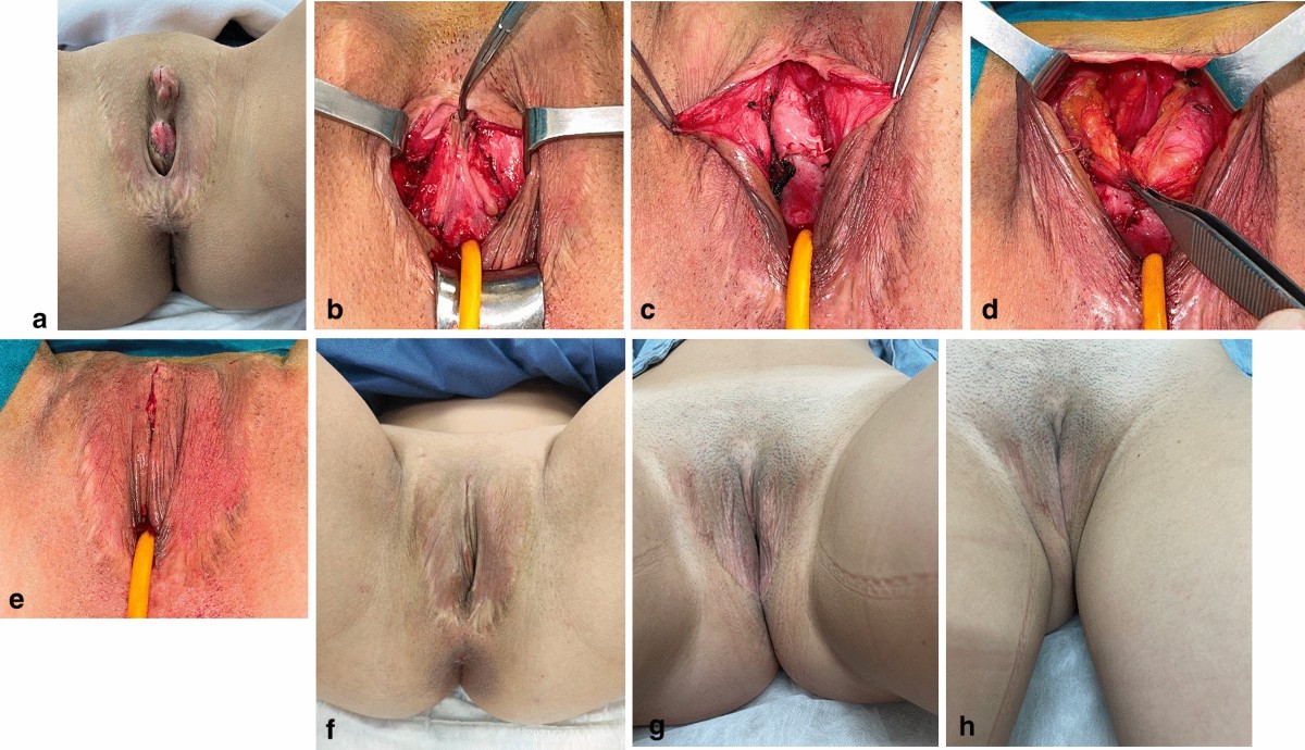 Cosmetic Revision Surgeries after Transfeminine Vaginoplasty | Aesthetic  Plastic Surgery