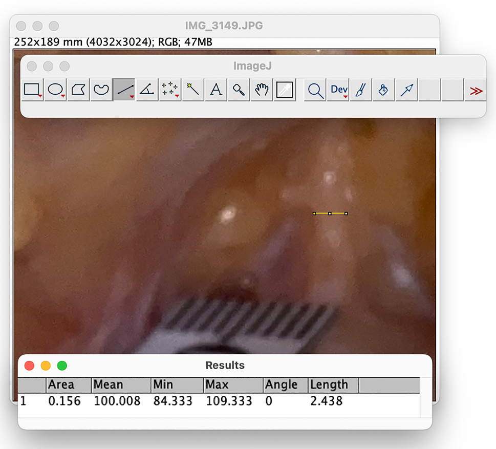 Morphometric Predictors of Penile Length Increase After Division of its Suspensory  Ligament | Aesthetic Plastic Surgery