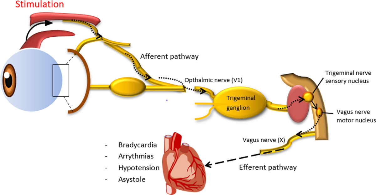 The Oculocardiac Reflex: A Rare but Significant Cardiovascular Complication  During Percutaneous Sclerotherapy of a Retro-Bulbar Low Flow Venolymphatic  Malformation | CardioVascular and Interventional Radiology | Springer  Nature Link