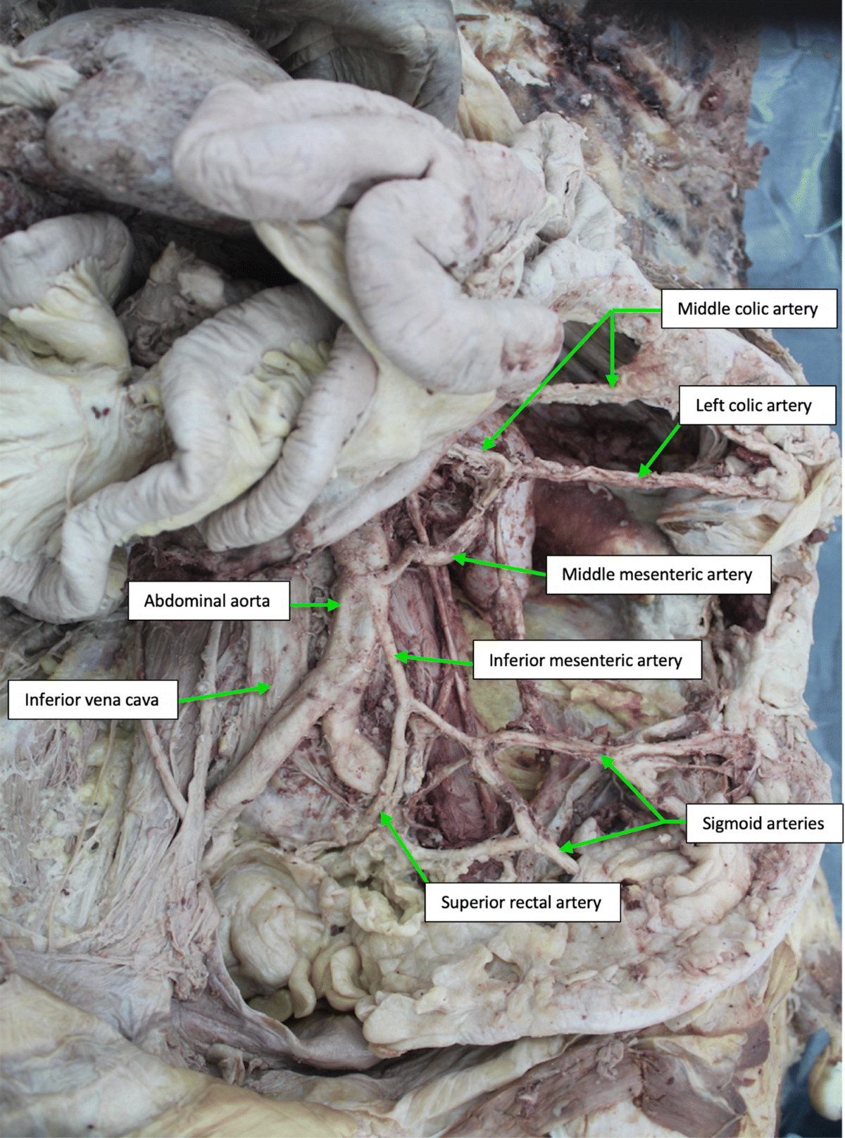 Imaging of Pancreatic Neoplasms - Surgical Oncology Clinics, image size:1200x1616