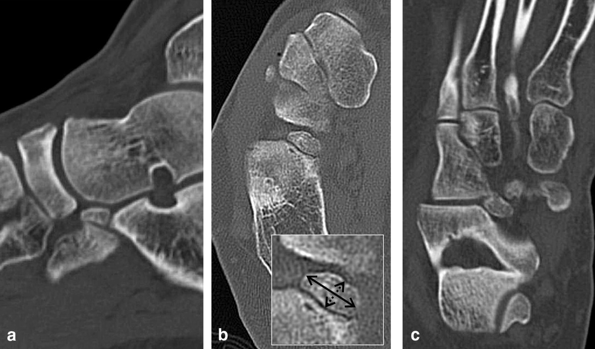 Os calcaneus secundarius, a relevant differential diagnosis to fracture or  pseudarthrosis of processus anterior of the calcaneus: a CT morphologic  description | Surgical and Radiologic Anatomy, image size:1200x704