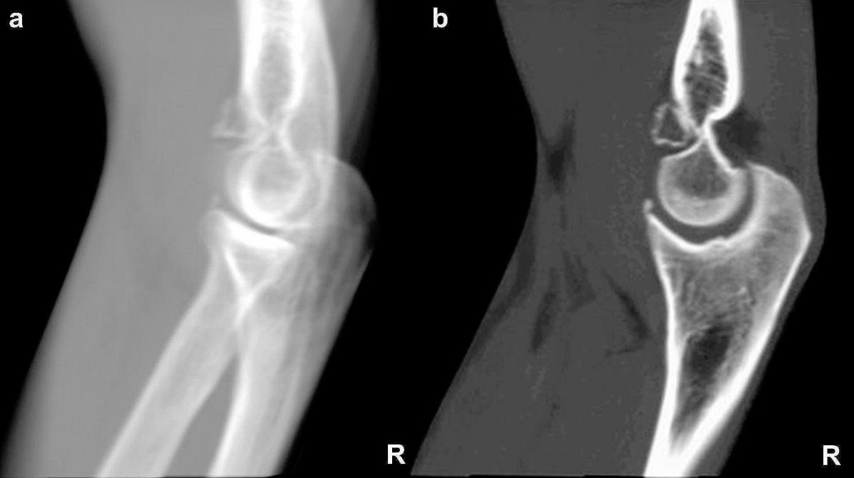 Os supratrochleare anterius: a very rare clinical case and review of  literature | Surgical and Radiologic Anatomy, image size:1200x672
