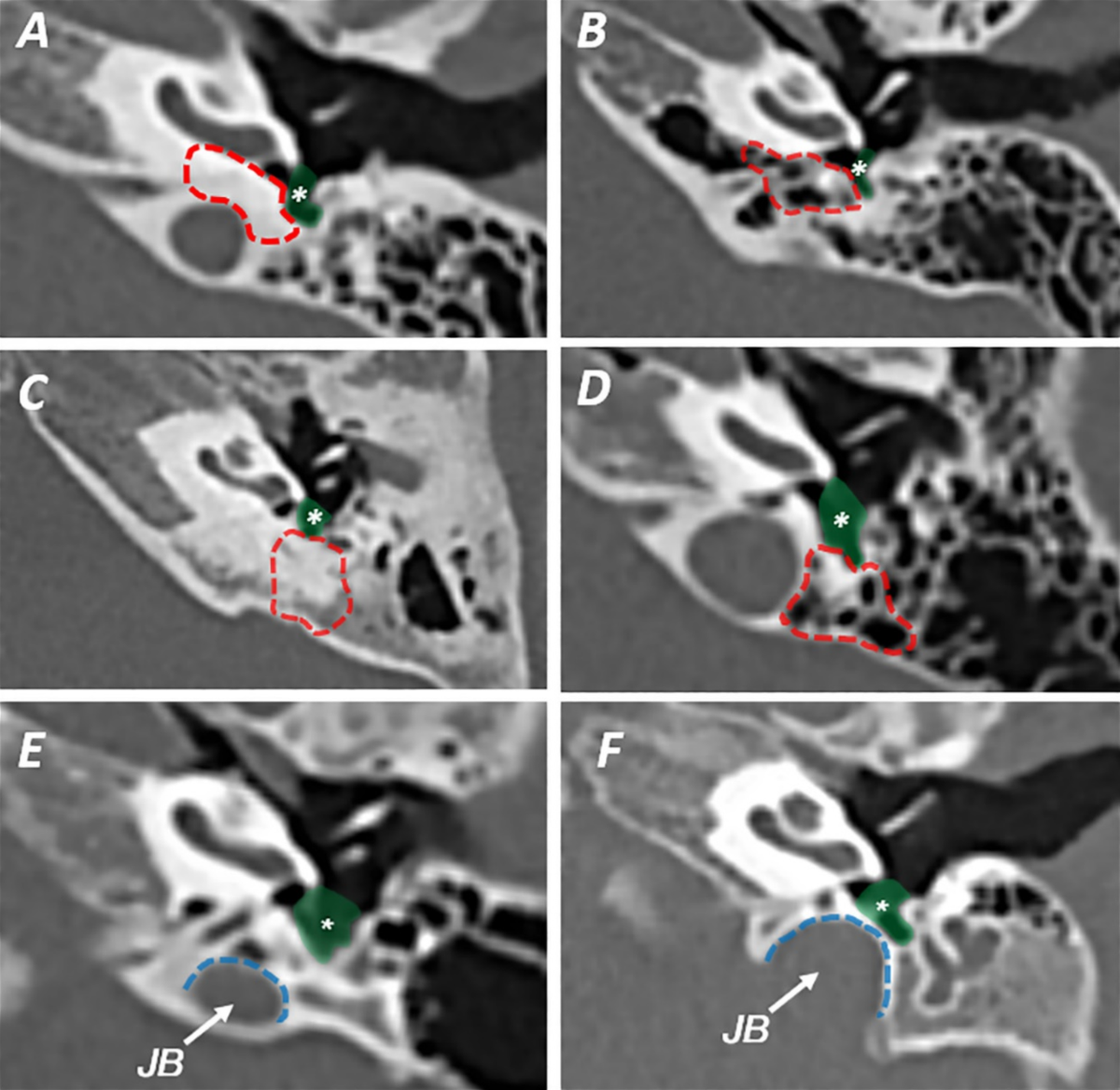 pyramidal eminence ct
