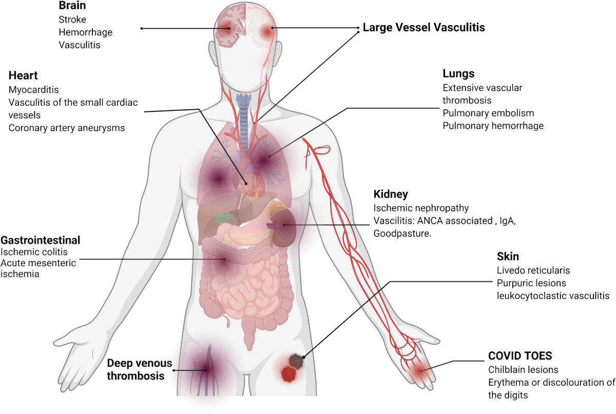 Vasculitis and vasculopathy-Causes-Symptoms-Diagnosis- | Homeopathic | Best Homeopathic Doctor in Pakistan | Dr Qaisar Ahmed MD, DHMS