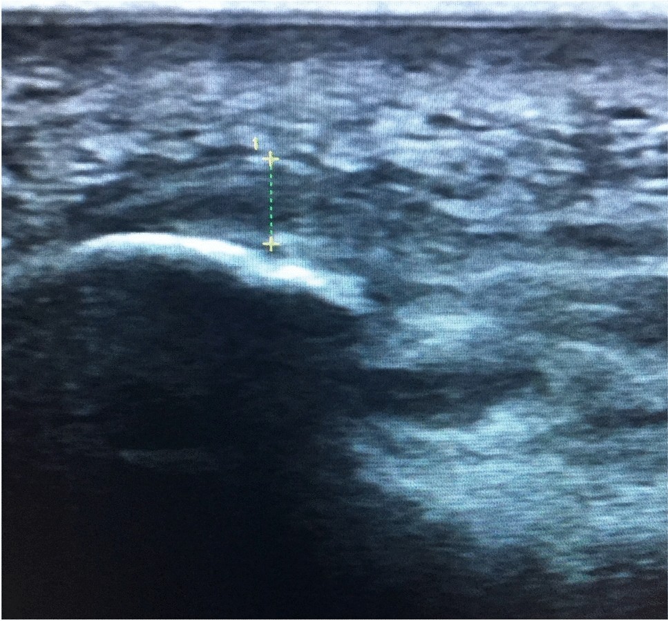 The efficacy and safety of extracorporeal shock wave therapy on plantar  fasciitis in patients with axial spondyloarthritis: a double-blind,  randomized controlled trial | Rheumatology International