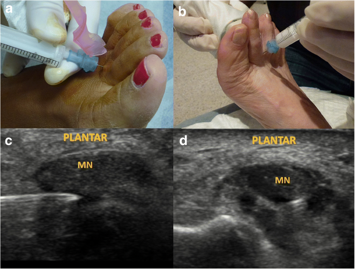 b12 injection for mortons neuroma Morton's Injection: Steroid Treatment Technique & Guide Alcohol Injection Therapy Toronto |